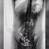 Scanner corporal identificou 32 porções de droga no corpo da adolescente de 13 anos - Foto Divulgação Sejuri