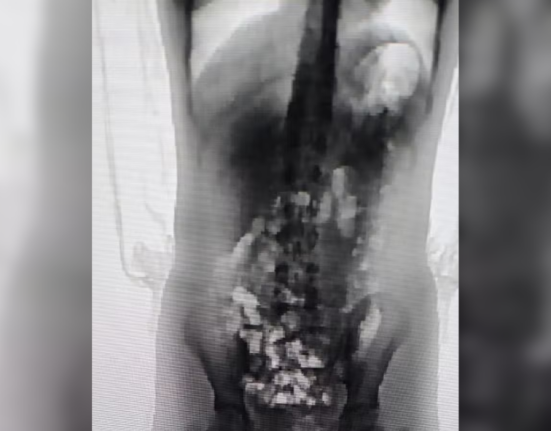Scanner corporal identificou 32 porções de droga no corpo da adolescente de 13 anos - Foto Divulgação Sejuri