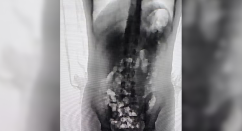 Scanner corporal identificou 32 porções de droga no corpo da adolescente de 13 anos - Foto Divulgação Sejuri
