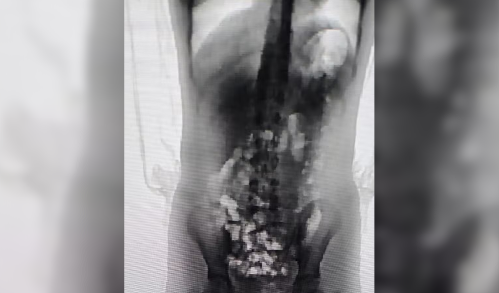 Scanner corporal identificou 32 porções de droga no corpo da adolescente de 13 anos - Foto Divulgação Sejuri